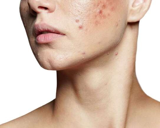 Acne scarring treatment