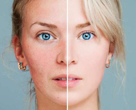 Rosacea Skin Treatment